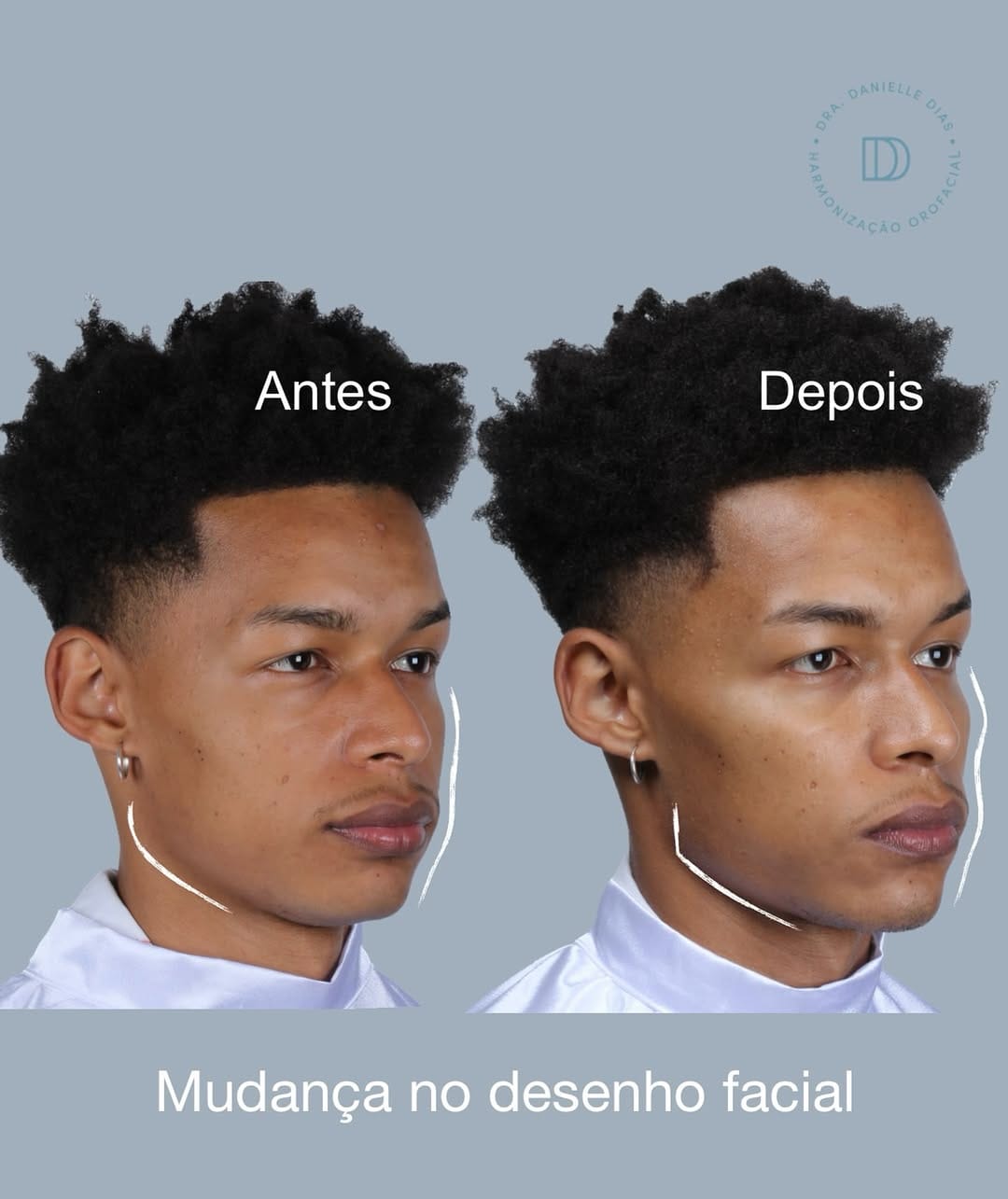 Post 9 by Danielle Dias • Harmonização Facial on Instagram (carousel)