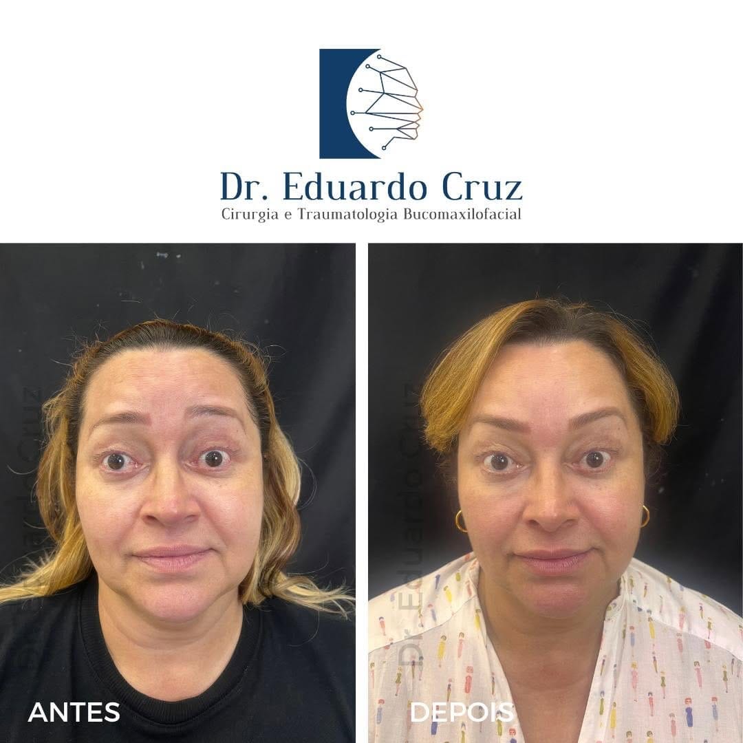 Post 1 by Prof. Dr. Eduardo Cruz  | Cirurgia Buco-Maxilo-Facial on Instagram (carousel)