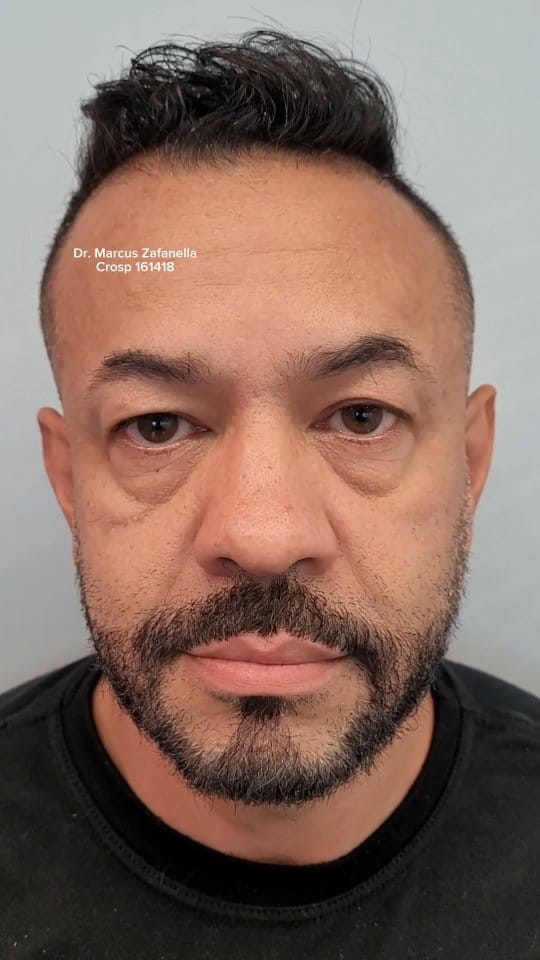 Post 9 by Dr Marcus Zafanella | Harmonização Facial on Instagram (video)