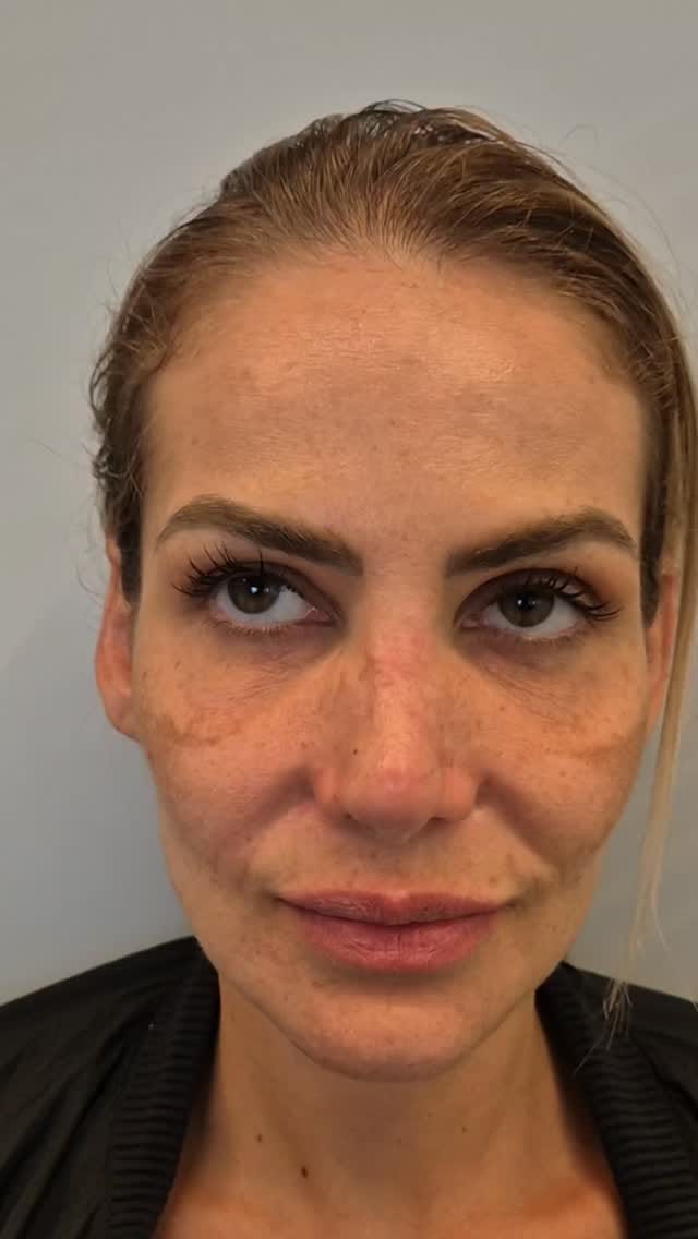 Post 3 by Dr Marcus Zafanella | Harmonização Facial on Instagram (video)