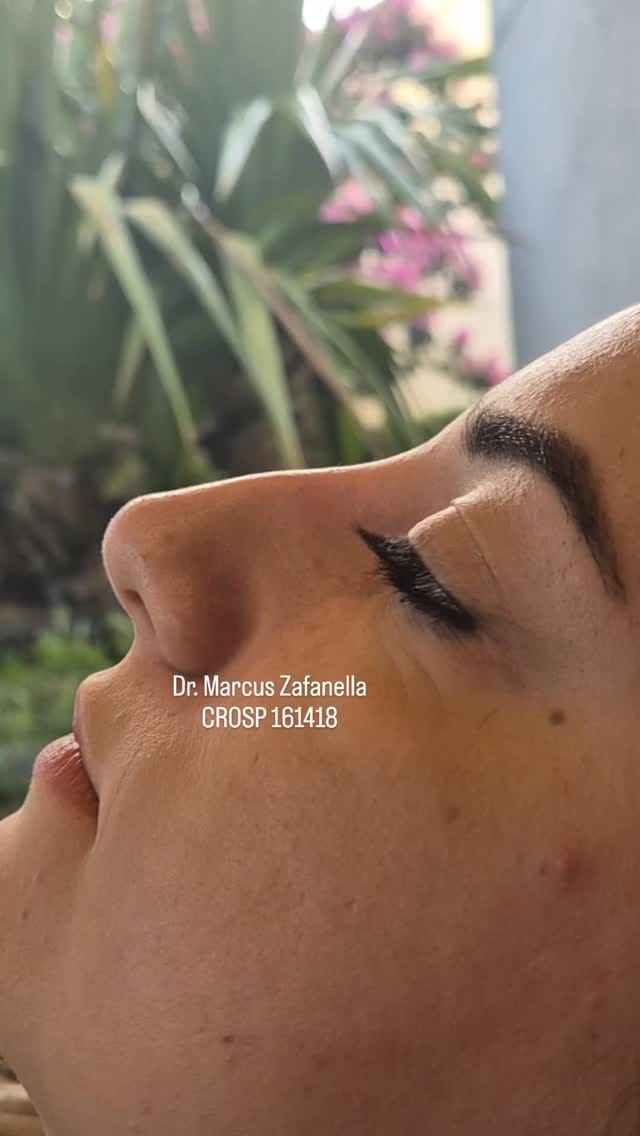 Post 4 by Dr Marcus Zafanella | Harmonização Facial on Instagram (video)