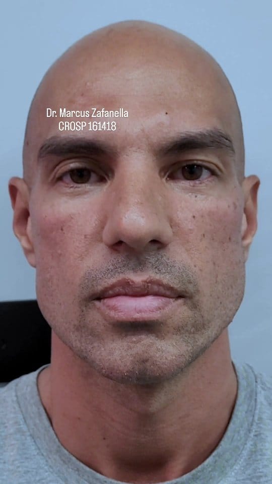 Post 10 by Dr Marcus Zafanella | Harmonização Facial on Instagram (video)