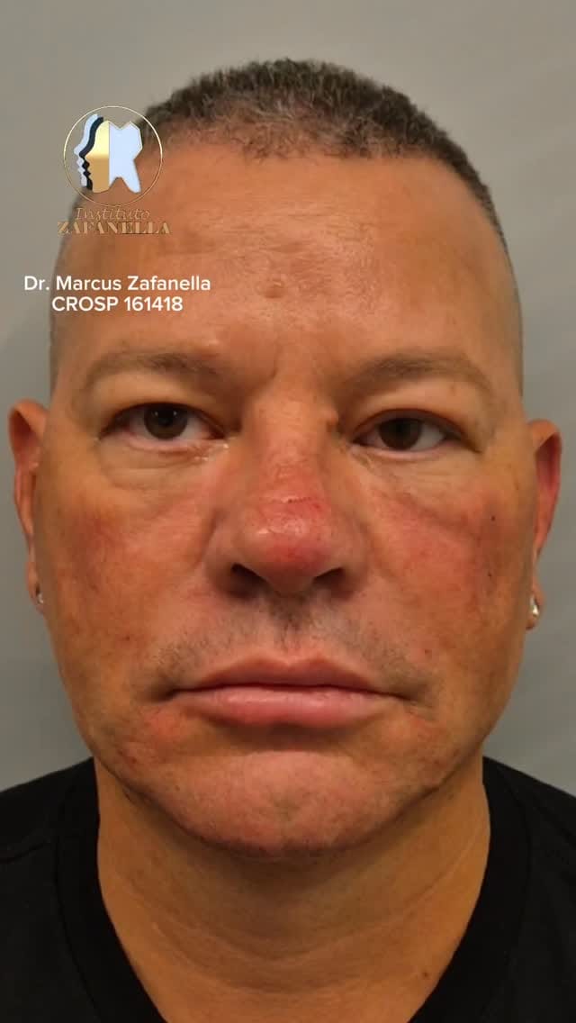 Post 5 by Dr Marcus Zafanella | Harmonização Facial on Instagram (video)