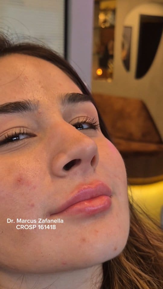 Post 2 by Dr Marcus Zafanella | Harmonização Facial on Instagram (video)