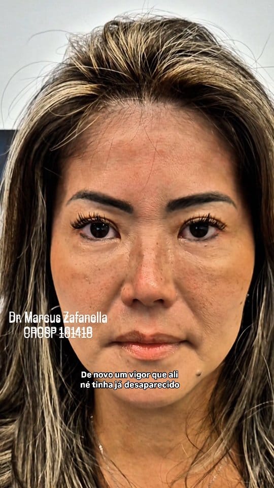 Post 6 by Dr Marcus Zafanella | Harmonização Facial on Instagram (video)