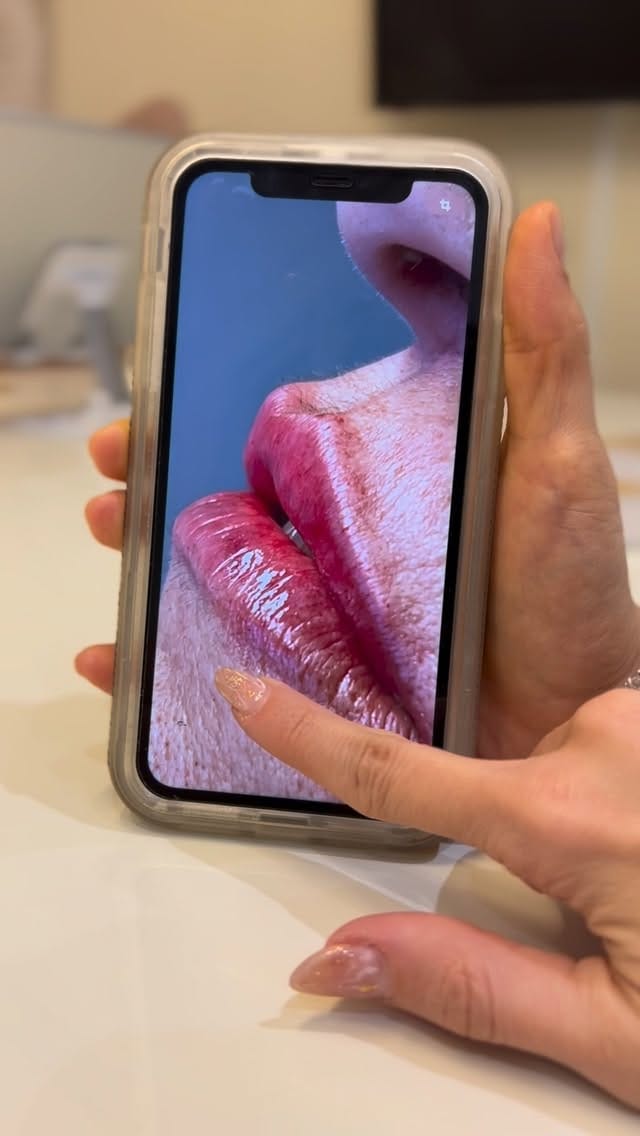 Post 4 by Dra. Nayara Xanthopulo | Especialista em Lábios on Instagram (video)