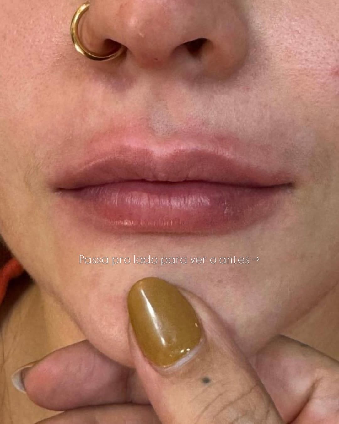 Post 2 by Dra. Gisele Santos  II Botox em Santos on Instagram (carousel)