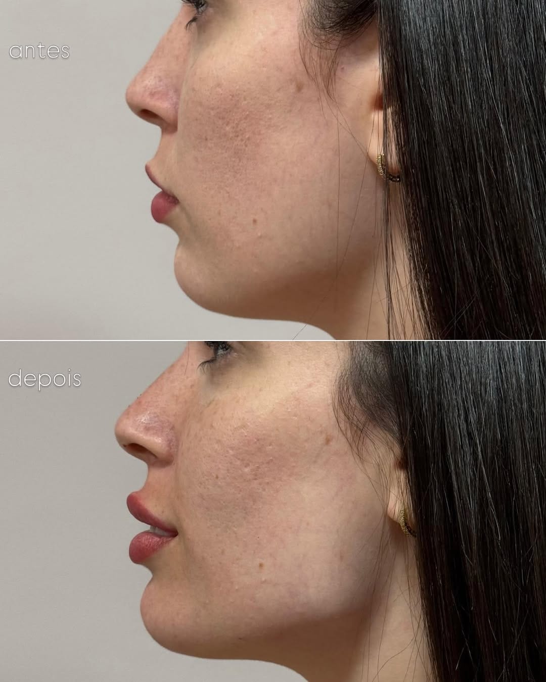 Post 6 by Dra. Gisele Santos  II Botox em Santos on Instagram (image)