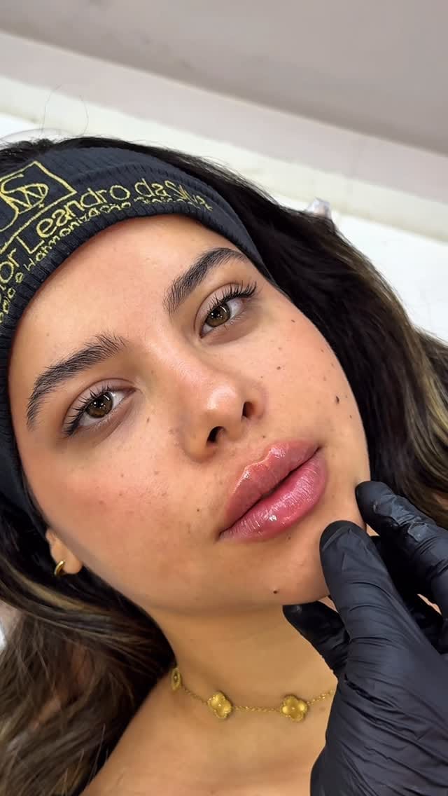 Post 10 by Dr. João Wictor Leandro | Harmonização orofacial on Instagram (video)