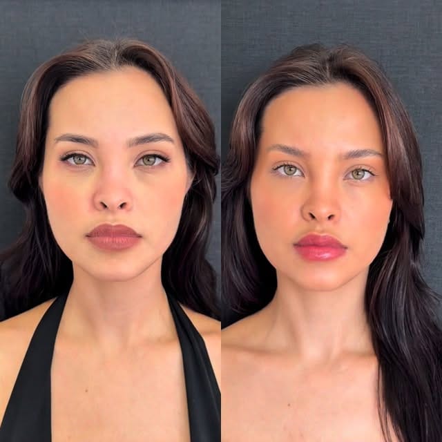 Post 8 by Dra. Thássia Marçal | Harmonização Facial | CRBM-12091 on Instagram (video)