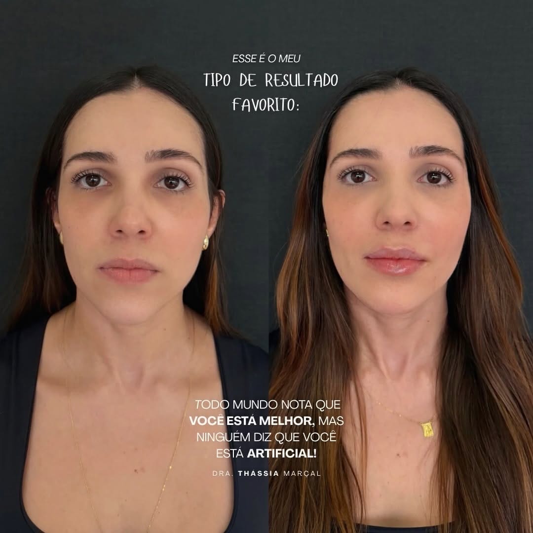 Post 6 by Dra. Thássia Marçal | Harmonização Facial | CRBM-12091 on Instagram (carousel)