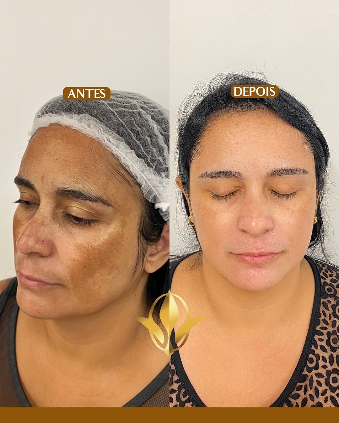 Post 8 by Invisible Melasma By Agnes Christie on Instagram (image)