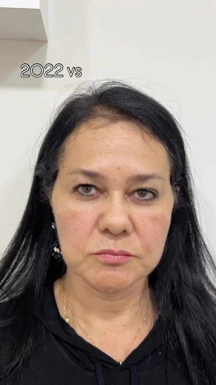 Post 10 by Instituto Faissal Campinas SP| Harmonização facial on Instagram (video)