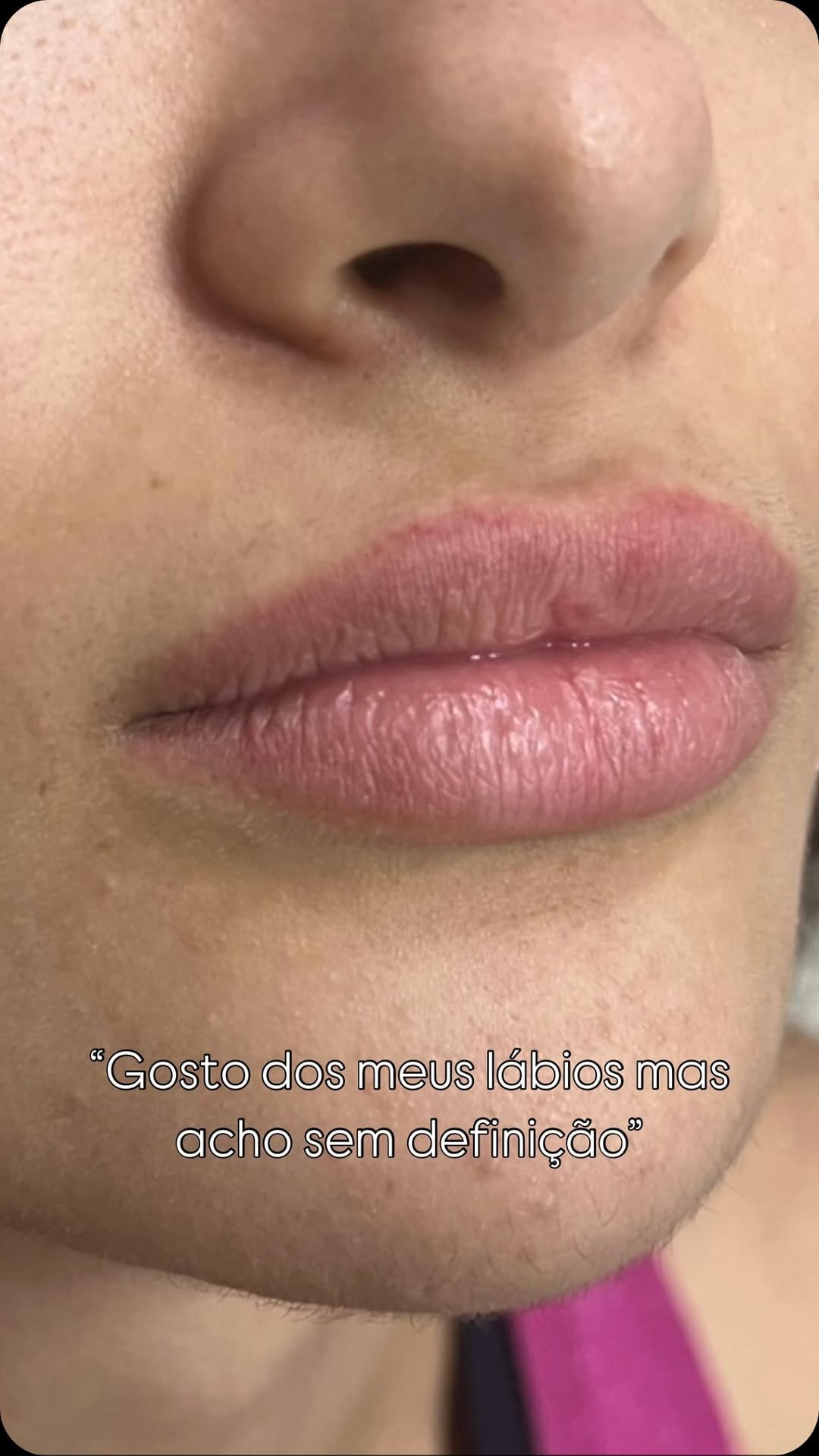 Post 5 by Instituto Faissal Campinas SP| Harmonização facial on Instagram (video)