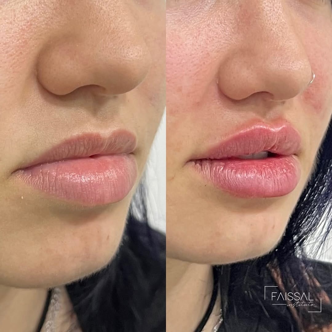 Post 7 by Instituto Faissal Campinas SP| Harmonização facial on Instagram (image)