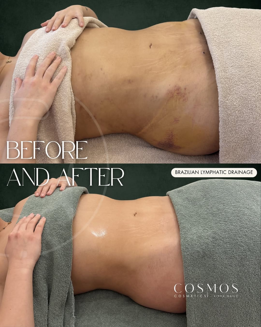 Post 7 by Vinka M. Brasilianische Lymphdrainage & Schulungen on Instagram (image)