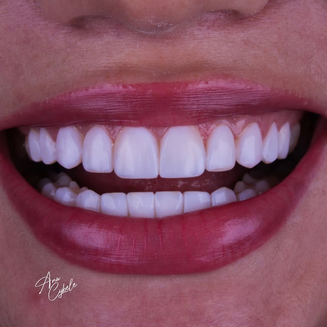 Post 10 by Dra. Cybele Queiroz | Odontologia Estética | Harmonização Facial on Instagram (image)