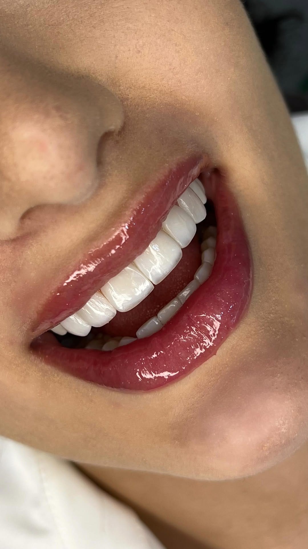 Post 9 by Dra. Cybele Queiroz | Odontologia Estética | Harmonização Facial on Instagram (video)