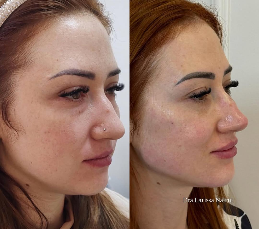 Post 6 by Larissa Nairni - Harmonização Facial on Instagram (carousel)