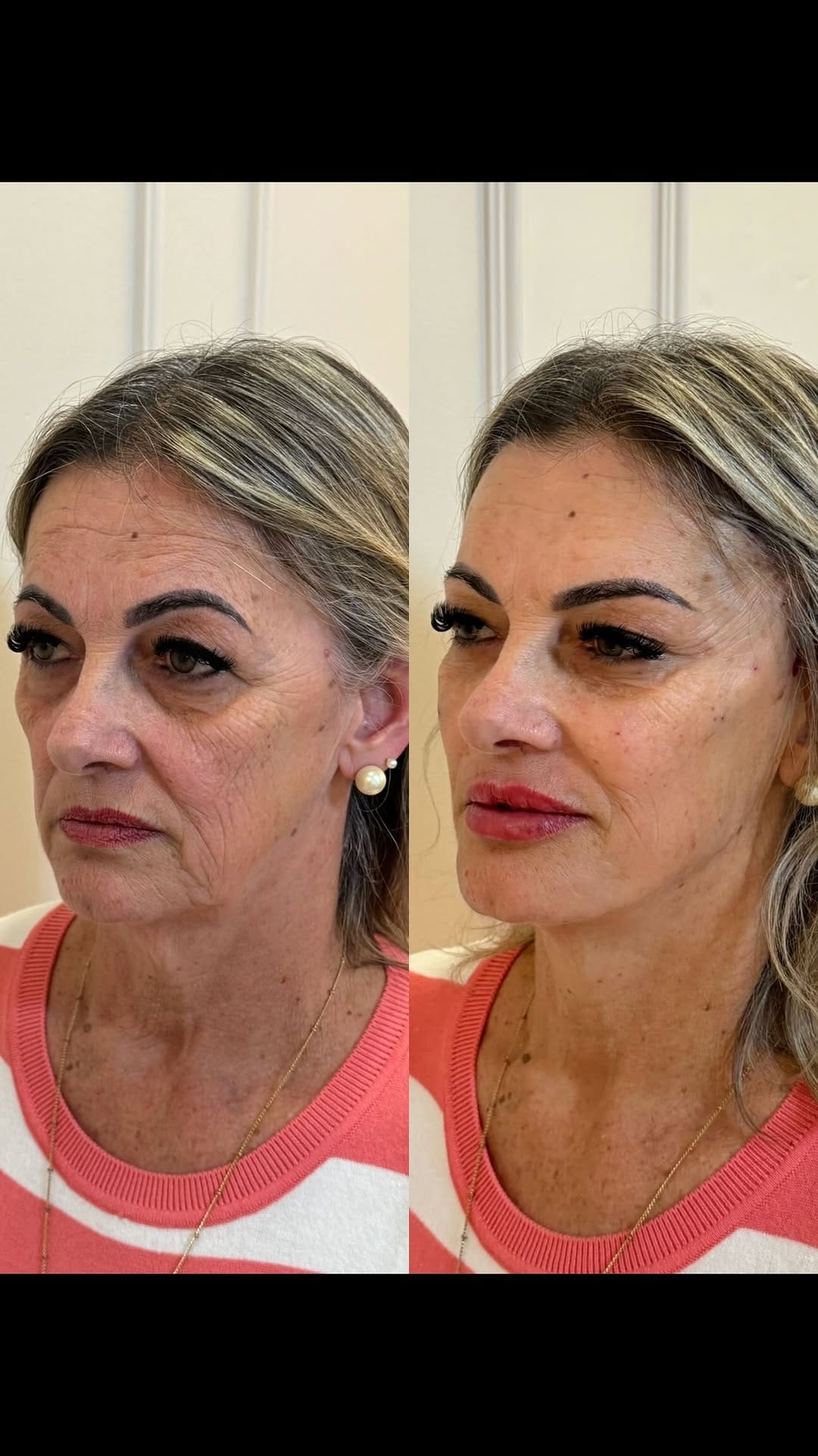 Post 9 by Larissa Nairni - Harmonização Facial on Instagram (video)