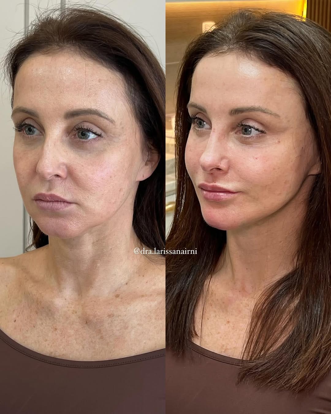 Post 10 by Larissa Nairni - Harmonização Facial on Instagram (carousel)