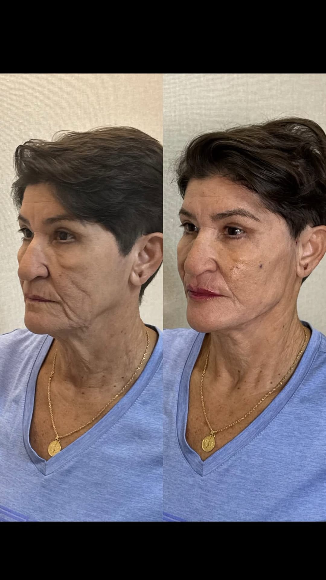 Post 4 by Larissa Nairni - Harmonização Facial on Instagram (video)