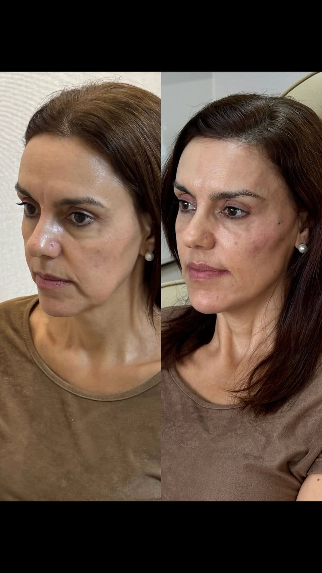 Post 8 by Larissa Nairni - Harmonização Facial on Instagram (video)