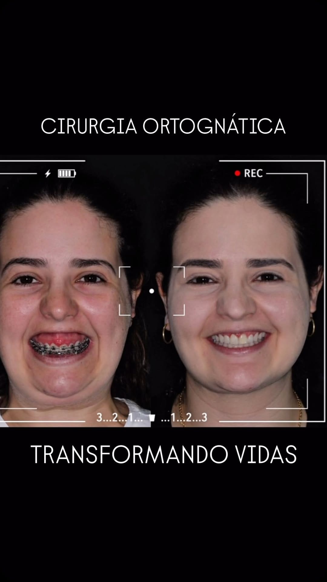 Post 9 by Dr. Luis Gustavo Paiva | Cirurgião Bucomaxilofacial em Goiânia on Instagram (video)