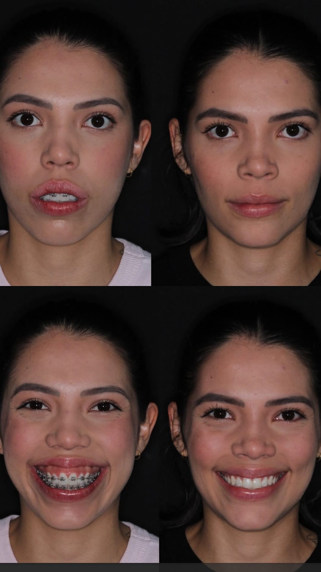 Post 4 by Dr. Luis Gustavo Paiva | Cirurgião Bucomaxilofacial em Goiânia on Instagram (video)