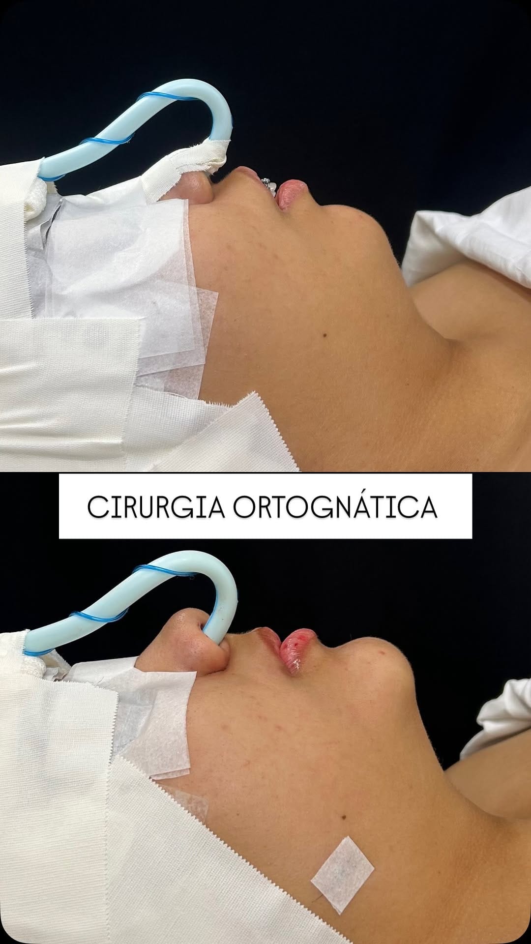 Post 3 by Dr. Luis Gustavo Paiva | Cirurgião Bucomaxilofacial em Goiânia on Instagram (video)