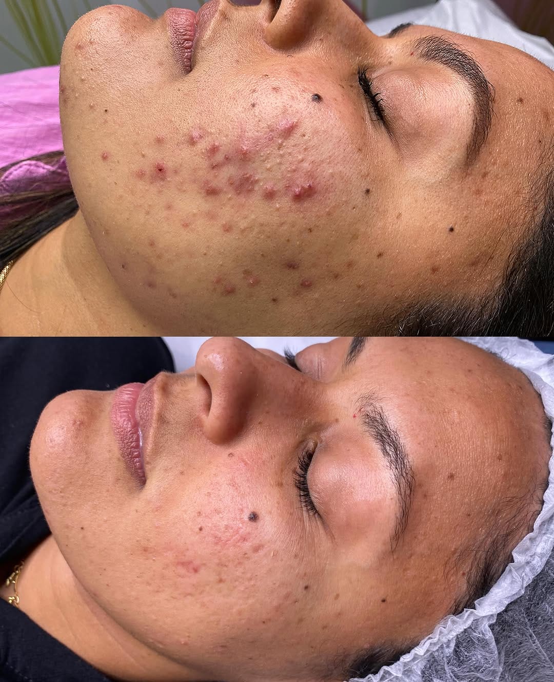 Post 4 by Fernanda Novaes | ESTETICISTA | ACNE / REJUVENESCIMENTO on Instagram (carousel)