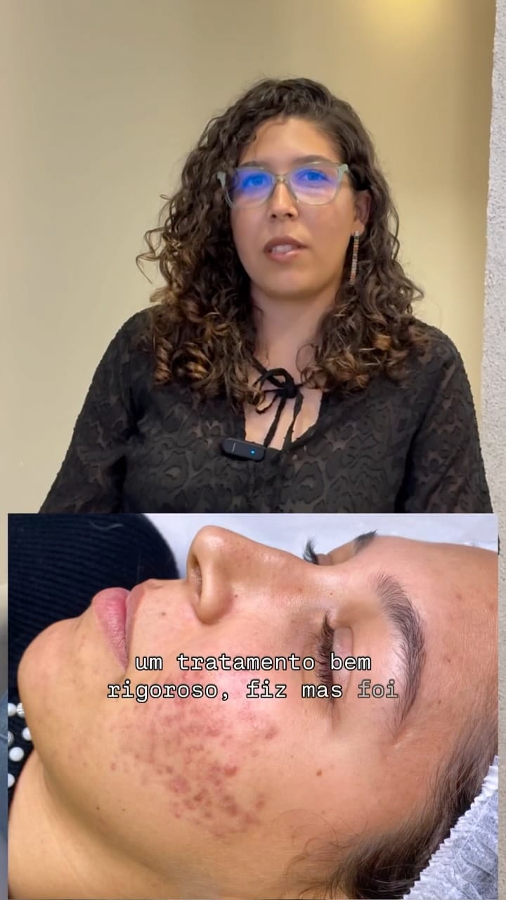 Post 8 by Fernanda Novaes | ESTETICISTA | ACNE / REJUVENESCIMENTO on Instagram (video)