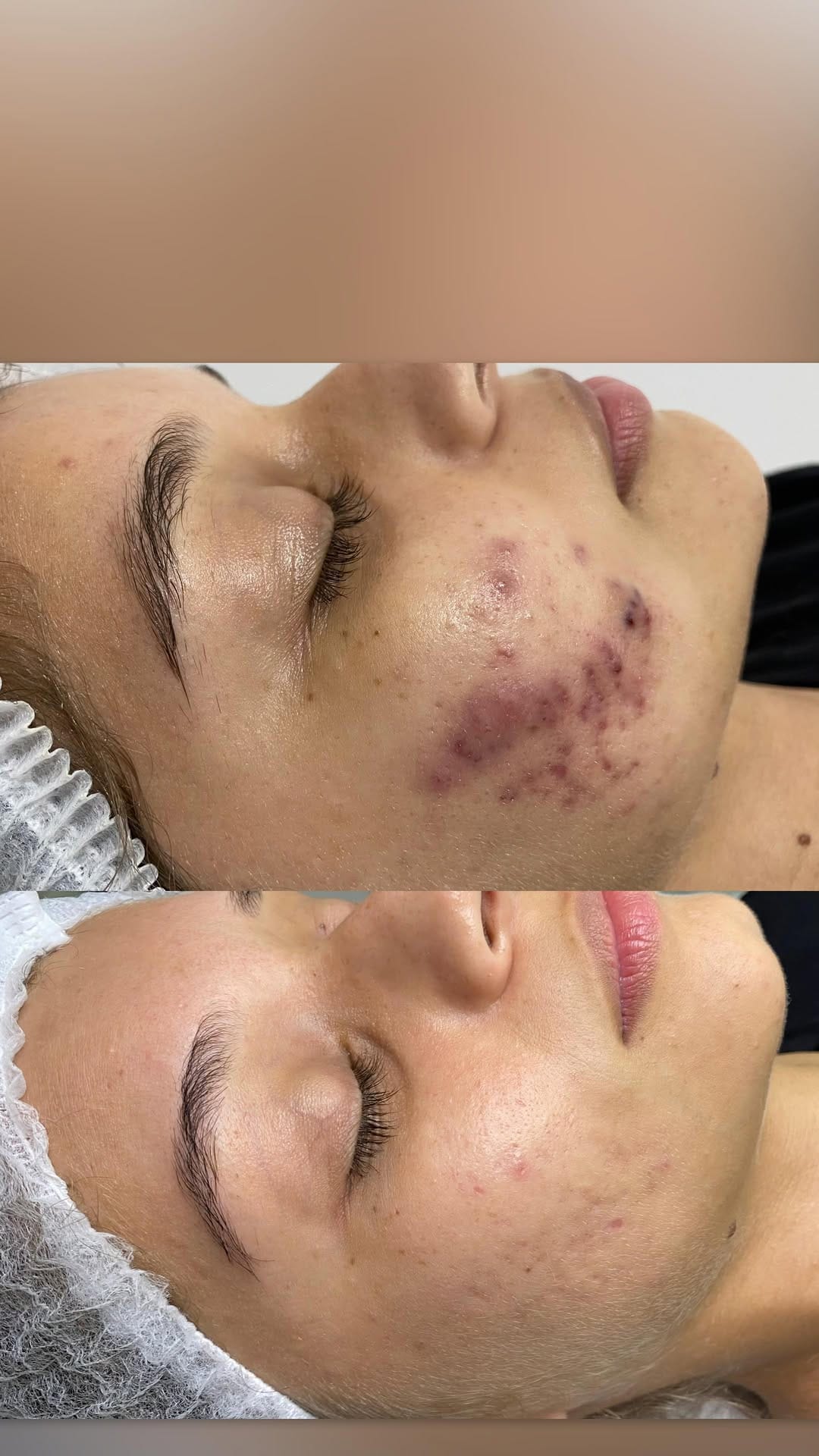 Post 9 by Fernanda Novaes | ESTETICISTA | ACNE / REJUVENESCIMENTO on Instagram (video)