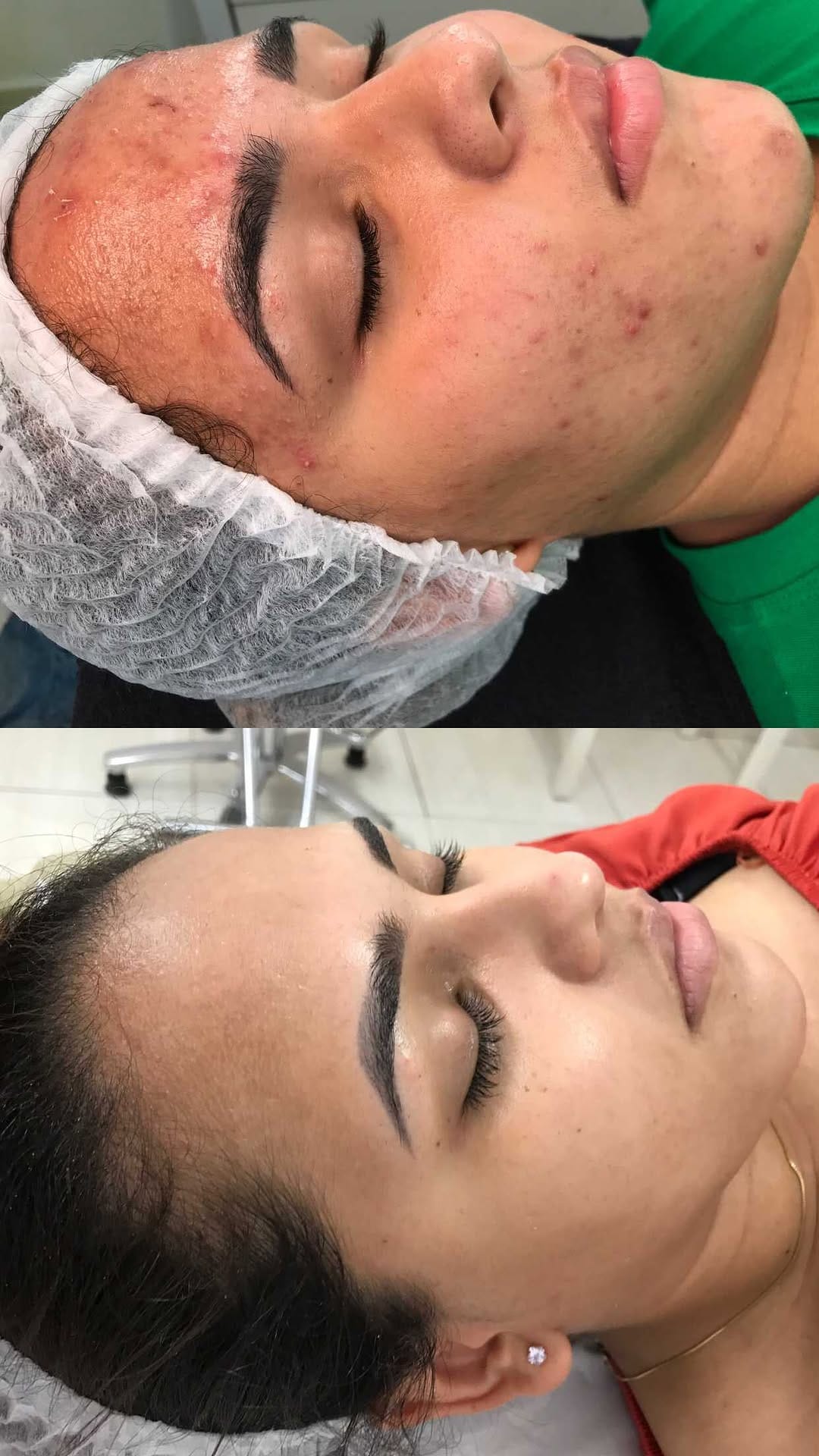 Post 10 by Fernanda Novaes | ESTETICISTA | ACNE / REJUVENESCIMENTO on Instagram (video)