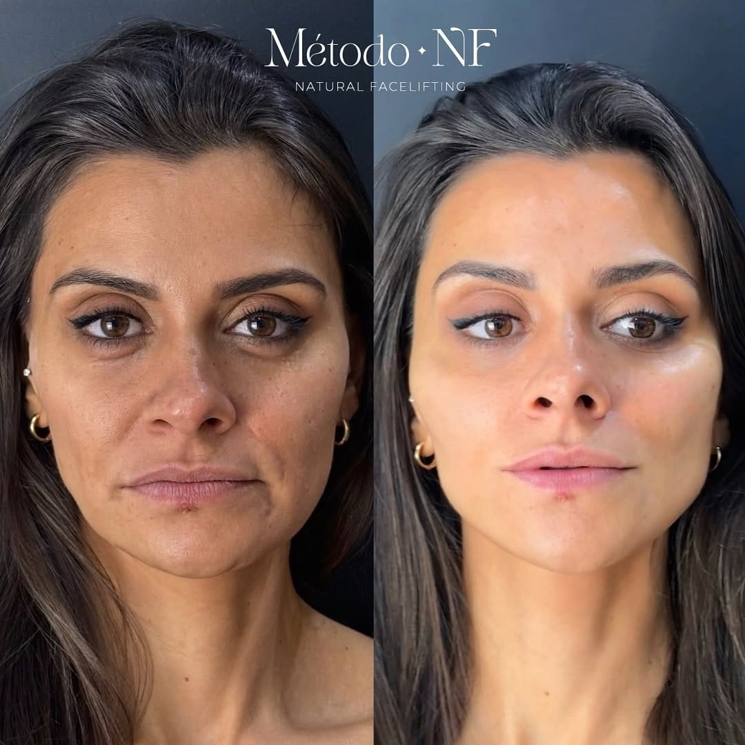 Post 10 by Dra Natália França - Instituto de Harmonização Facial on Instagram (carousel)