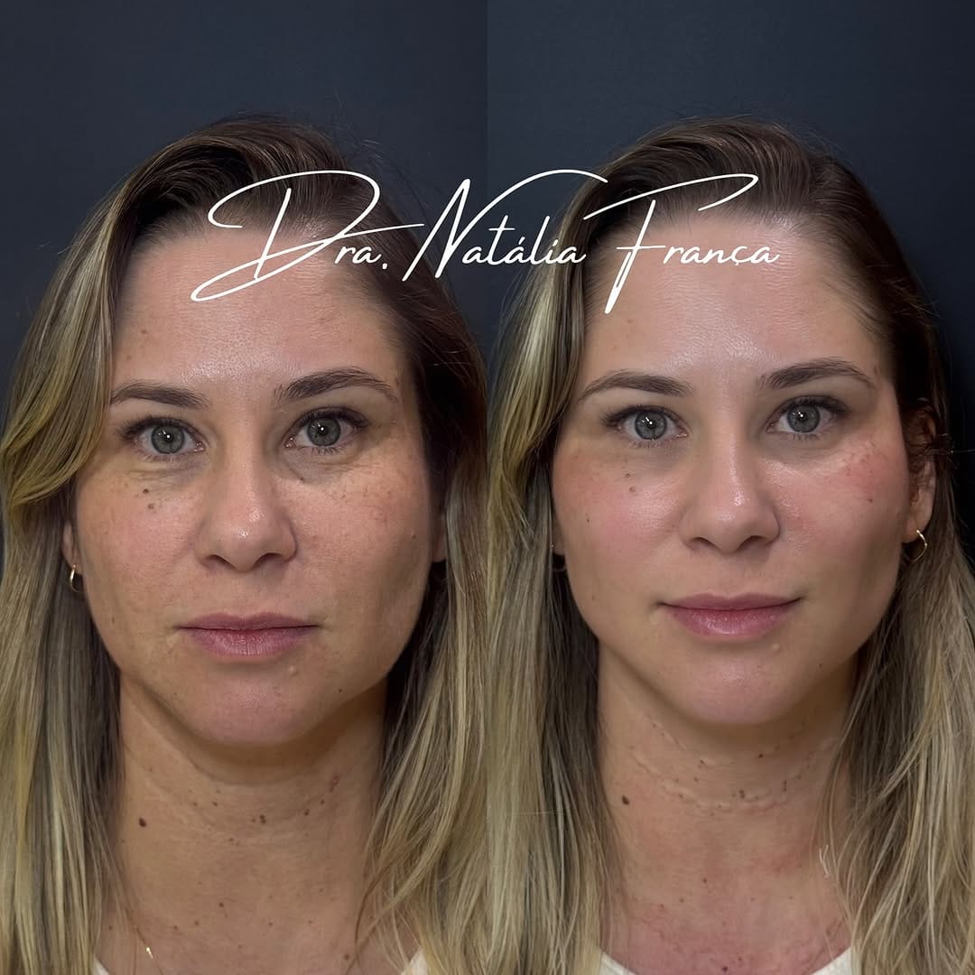 Post 9 by Dra Natália França - Instituto de Harmonização Facial on Instagram (carousel)