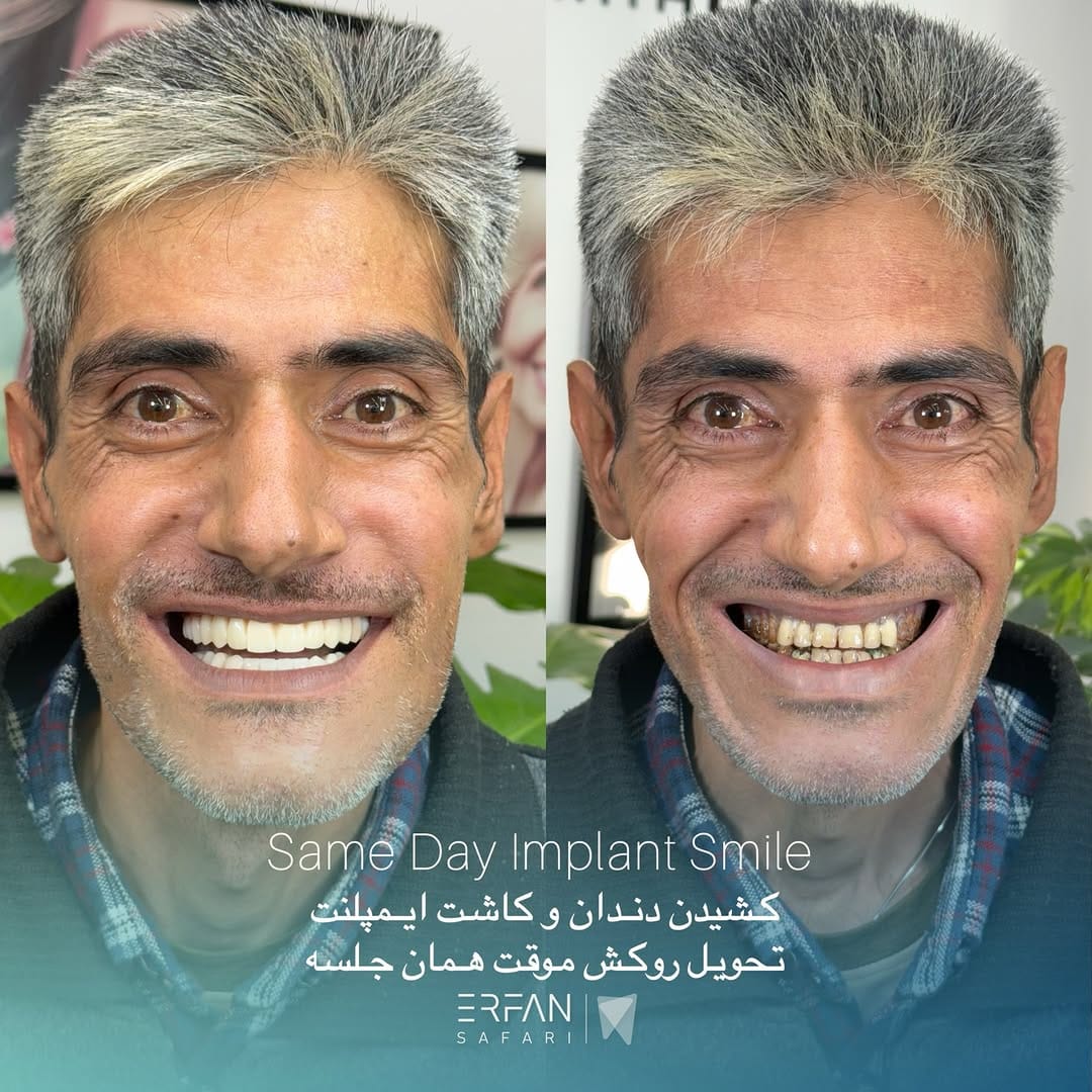 Post 9 by ایمپلنت شیراز عرفان صفری on Instagram (carousel)