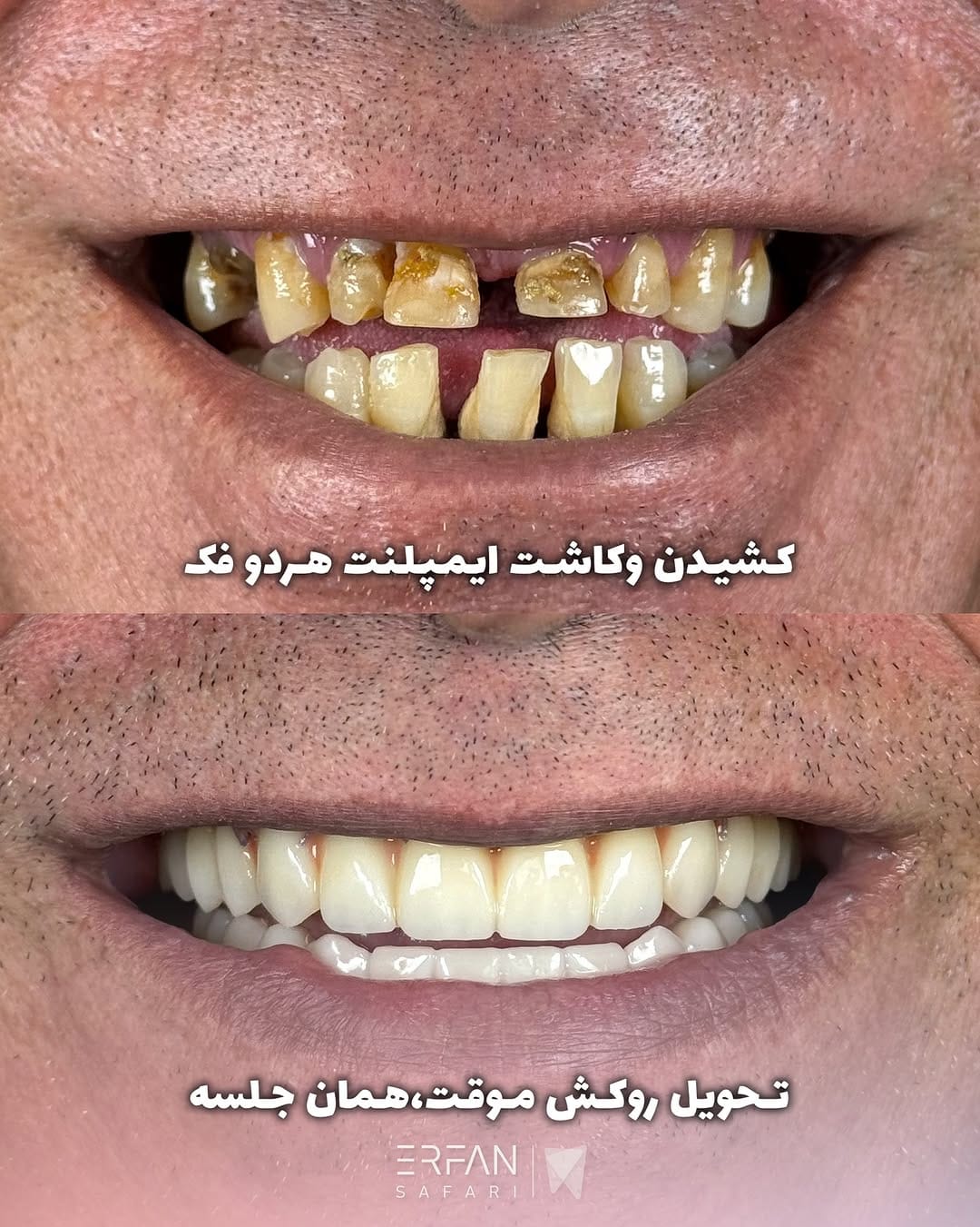 Post 10 by ایمپلنت شیراز عرفان صفری on Instagram (carousel)