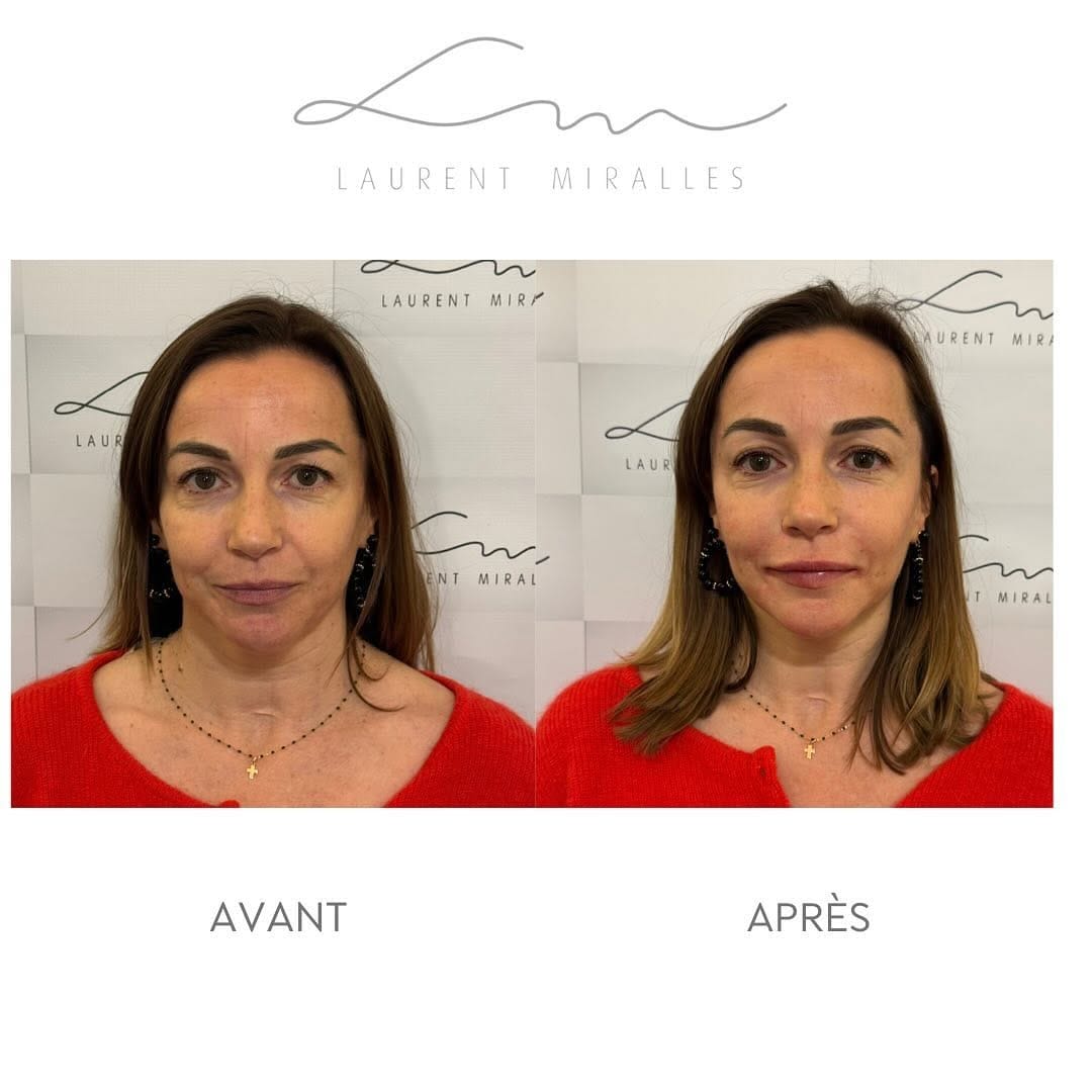 Post 5 by Dr. Laurent Miralles on Instagram (carousel)