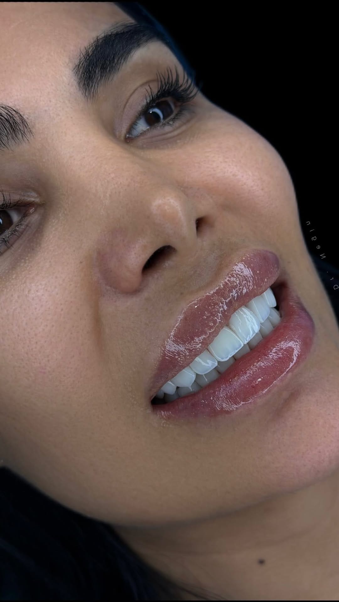 Post 4 by Dr. Negin Shahabzadeh , BDS on Instagram (video)