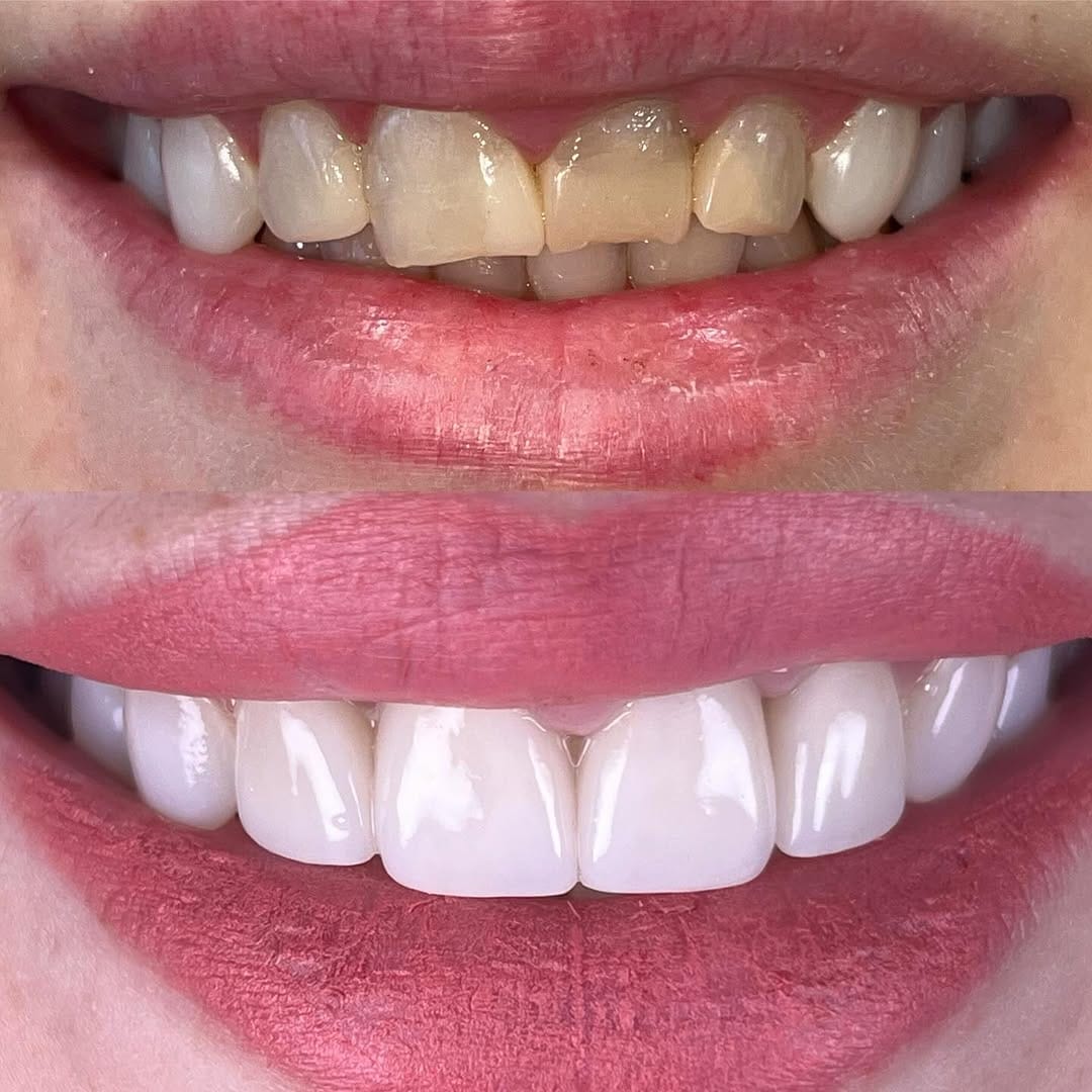 Post 4 by Dr. Egle Simkute cosmetic dentist Dubai on Instagram (image)