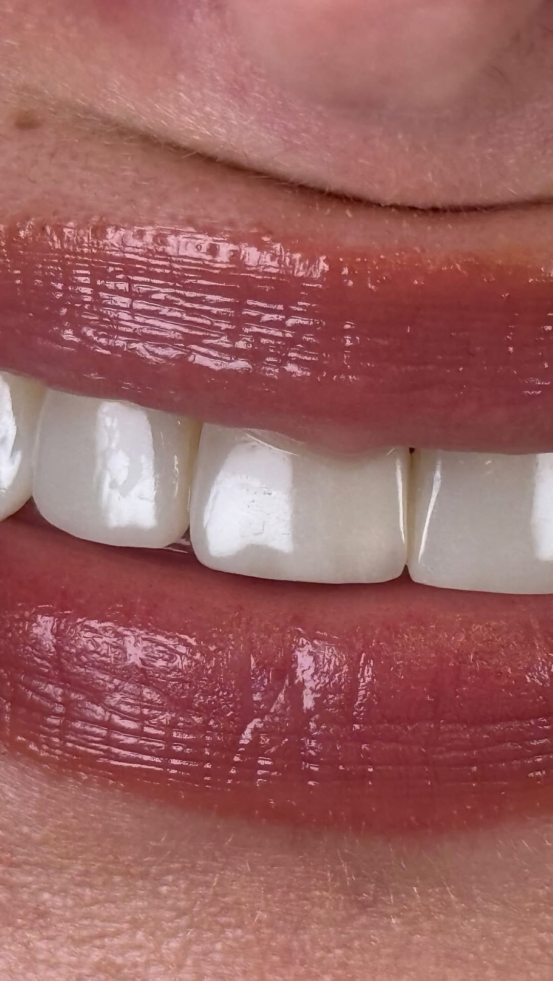 Post 1 by Dr. Egle Simkute cosmetic dentist Dubai on Instagram (video)