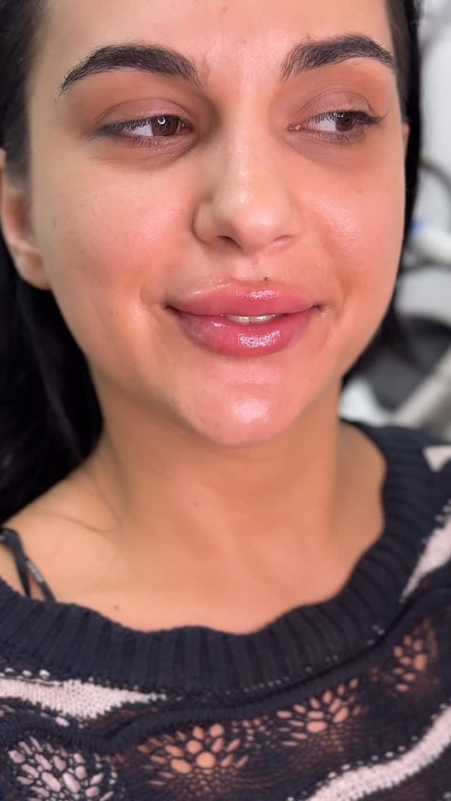 Post 5 by Dr. Beyan El Emin | Dermatology & Aesthetics on Instagram (video)