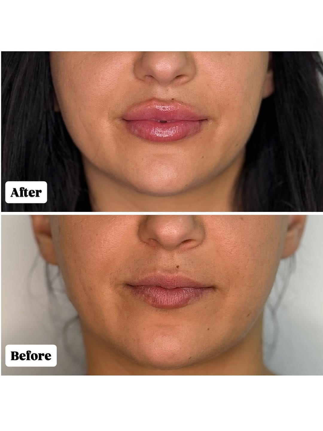 Post 3 by Dr. Beyan El Emin | Dermatology & Aesthetics on Instagram (image)