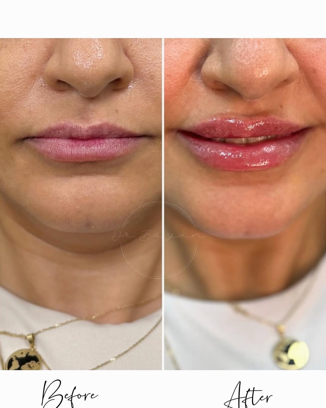 Post 10 by Dr. Beyan El Emin | Dermatology & Aesthetics on Instagram (image)