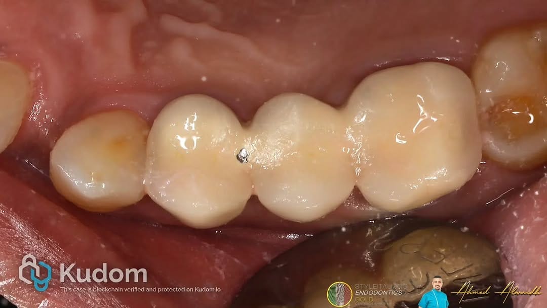 Post 2 by Dr. Ahmed Alwaidh BDS, LDS RCS ENG, MSc KCL د.احمد الواعظ on Instagram (carousel)