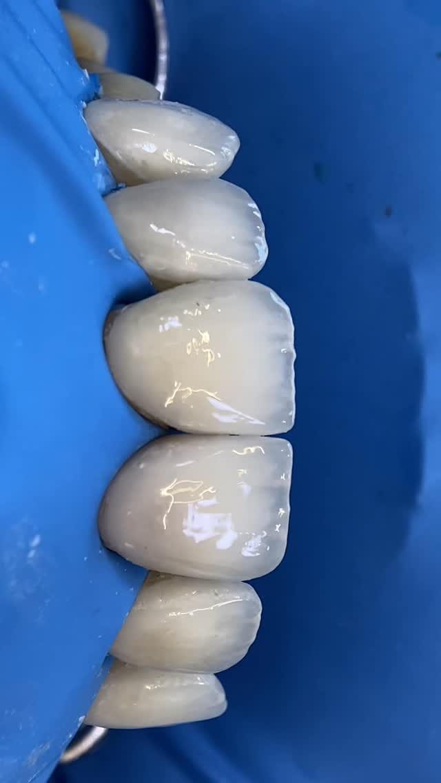 Post 8 by Dr Ahmad zebari implants & cosmetic د أحمد زيباري زراعة و تجميل on Instagram (video)