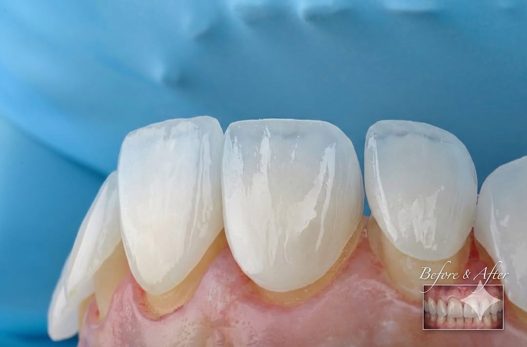Post 4 by Dr Ahmad zebari implants & cosmetic د أحمد زيباري زراعة و تجميل on Instagram (image)