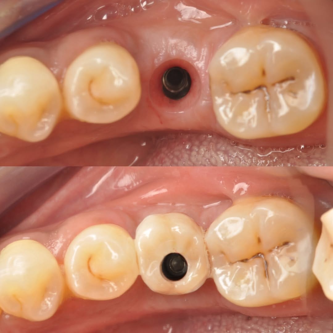 Post 5 by Dr Ahmad zebari implants & cosmetic د أحمد زيباري زراعة و تجميل on Instagram (image)