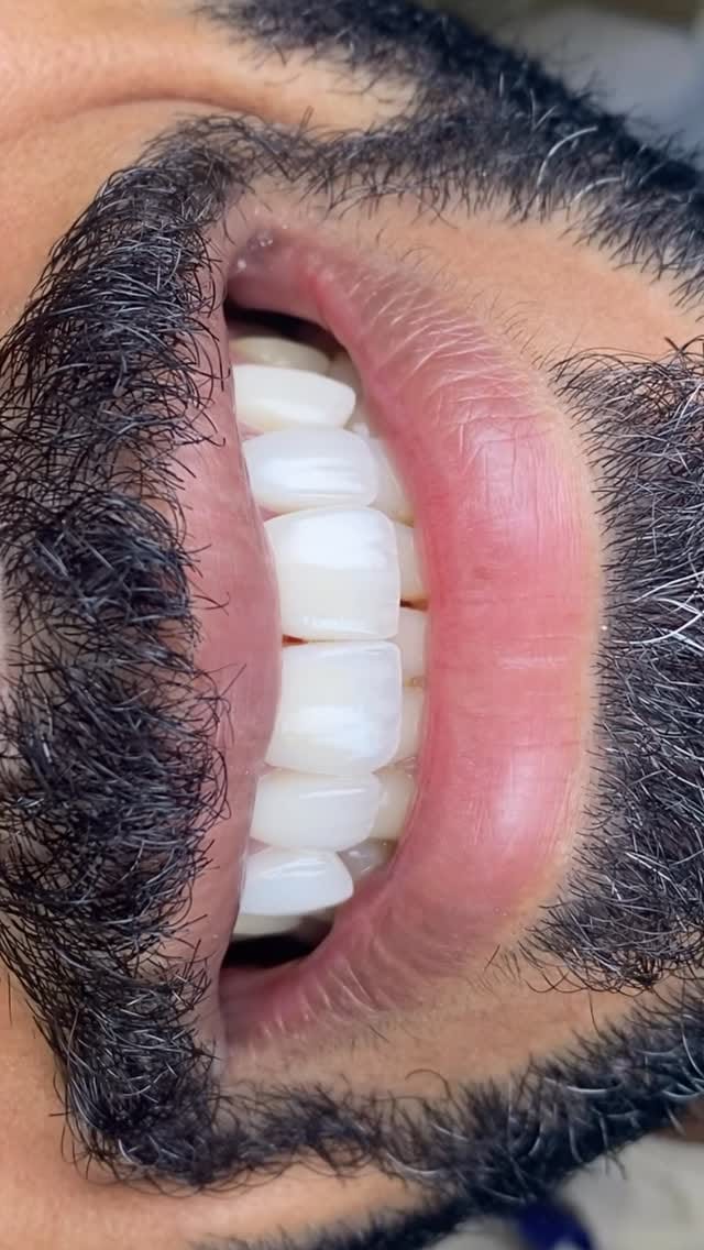 Post 1 by Dr Ahmad zebari implants & cosmetic د أحمد زيباري زراعة و تجميل on Instagram (video)